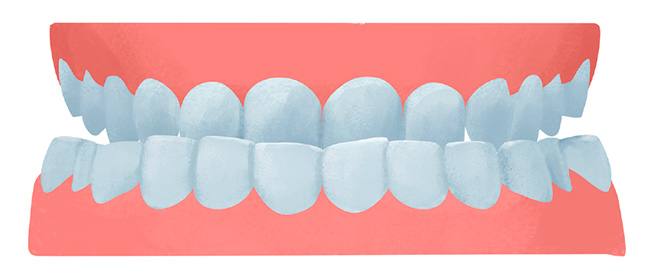 malocclusie of onderkaak prognathie